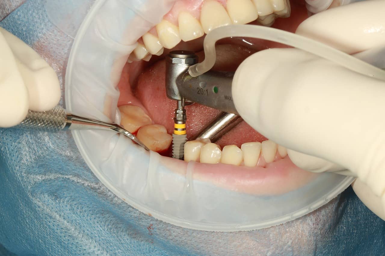 implante dental Majadahonda