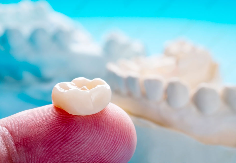 Prótesis Dentales Majadahonda muestra dental