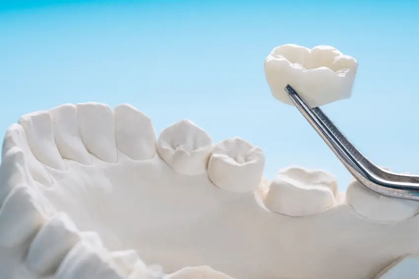 protesis-dentales-majadahonda-corona-dental